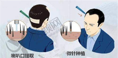 四、福州重森植发实例
