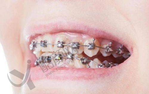 昆明尚爱韩美口腔医院孙亚杰医生做金属牙齿矫正价格5600元起,数字化正畸超靠谱