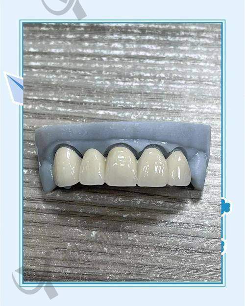 深圳新安麦芽口腔郑苍尚医生做钴铬烤瓷牙780元/颗,实惠价打造美观坚固牙齿新体验