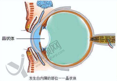 九江爱尔眼科医院白内障手术优势大揭秘