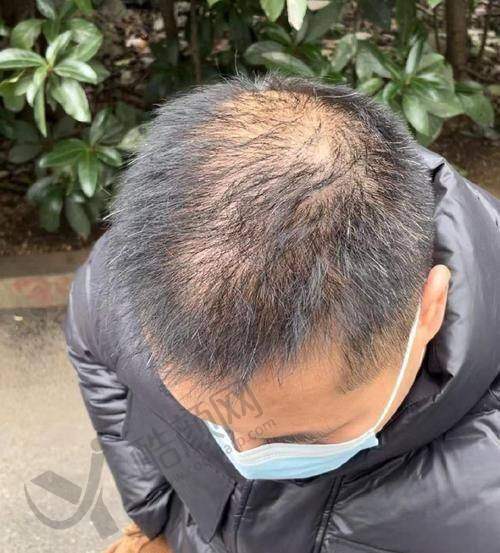 六、福州重森植发怎么预约：