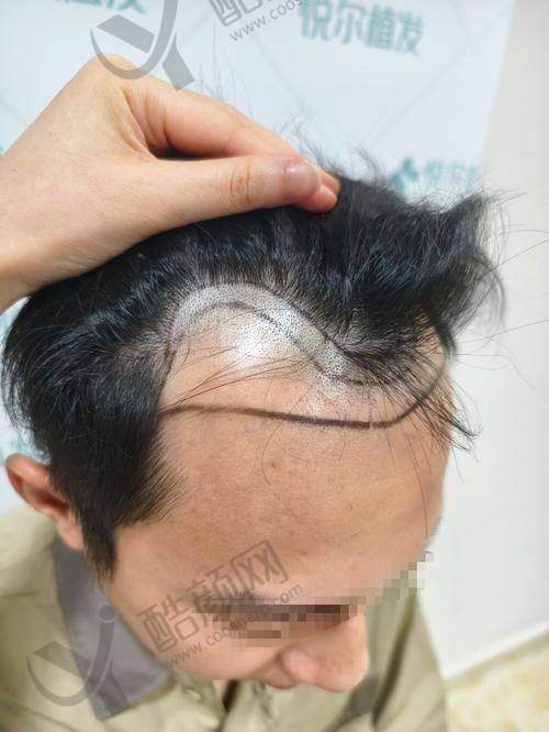 碧莲盛植发医生团队实力强