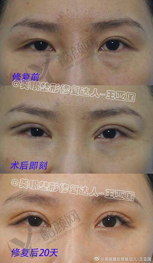 吕方中医生修复双眼皮口碑咋样?技术娴熟审美在线,个性化方案获患者高度赞誉