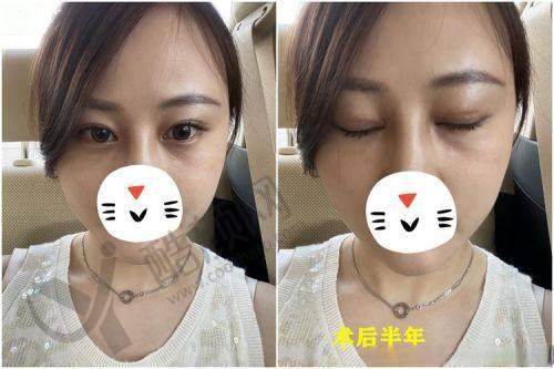 吕方中医生修复双眼皮技术特点：技术娴熟，审美在线