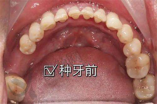 上海城本口腔程勇种植牙实例