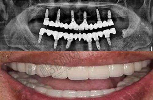 濮阳柏林牙医口腔李亚平医生做仕诺康种植牙价格6000元起,正规连锁收费合理服务优