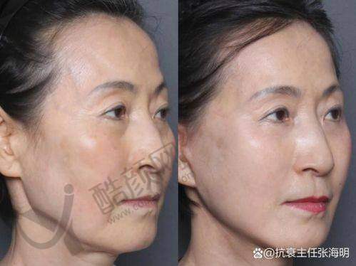 英伦大提升与超声炮：成效表现大对比，谁是速战速决派？