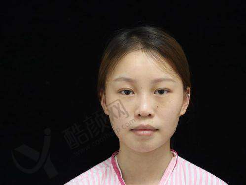 天津坤如玛丽医院进口假体+耳软骨隆鼻仅需5980元,专业团队打造个性美鼻!
