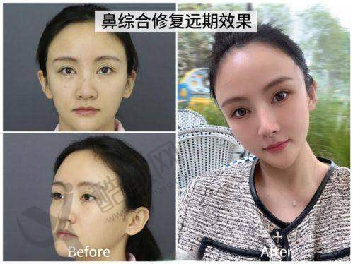 天津坤如玛丽医院进口假体+耳软骨隆鼻优势