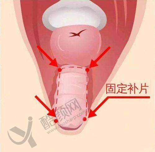 昆明吴氏嘉美医疗美容医院：八爪鱼紧缩术性价比之选