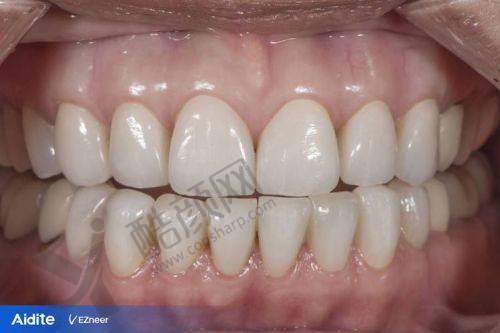 汉中小虎牙口腔张冬生医生做爱尔创全瓷牙冠2200元起,透明收费技术靠前!