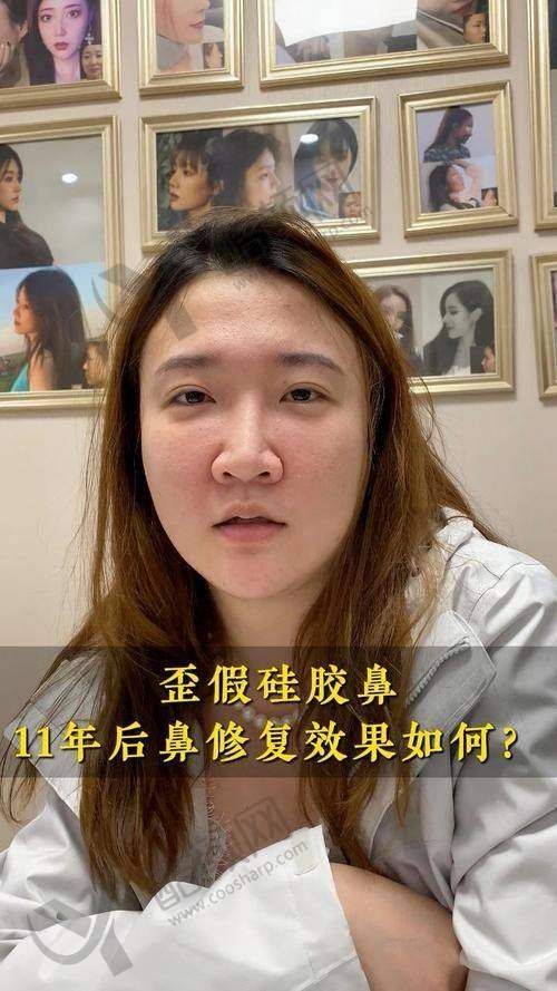 北京沃尔赵丹鼻修复实例