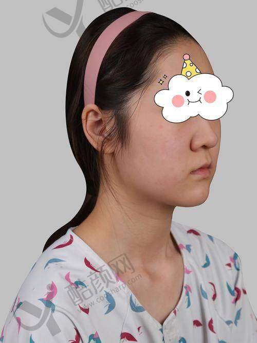 北京沃尔冯雁平肋软骨鼻修复实例
