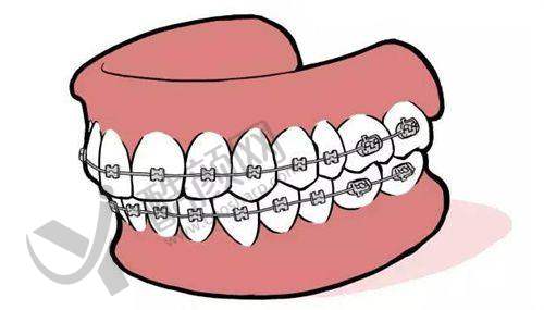 广州穗华口腔王林eBrace个性化舌侧矫治实例