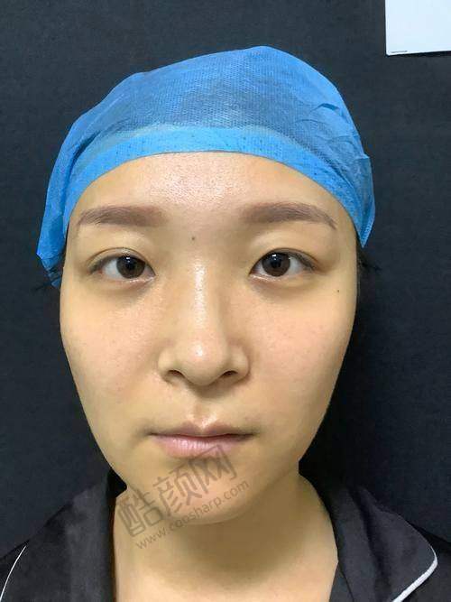 郑州星颜颂柳晓燕双眼皮修复价格及预约方式