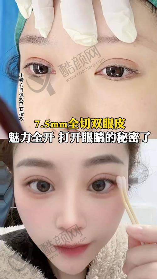 王太玲眼部整形实例