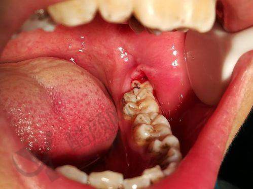 吴江金铂利口腔拔智齿价格380元起,透明收费体系助您精准规划口腔治疗预算