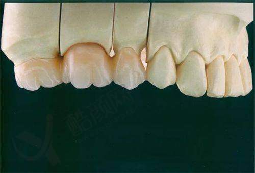 沈阳国信口腔田隽医生做爱尔创全瓷牙1288元起,美观耐用助您重拾自信笑容!