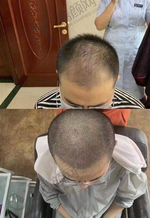 兰州碧莲盛植发：连锁品牌，技术领跑