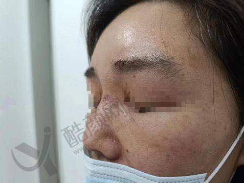 周云超取唇部注射物的成功实例