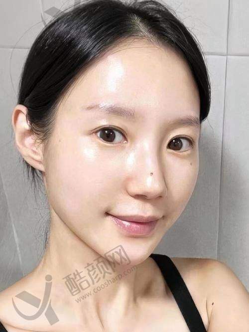 杨欣微创筋膜悬吊提升手术水平怎么样可靠吗？