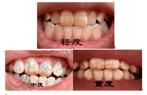 潍坊华贝口腔嵌体修复的优势