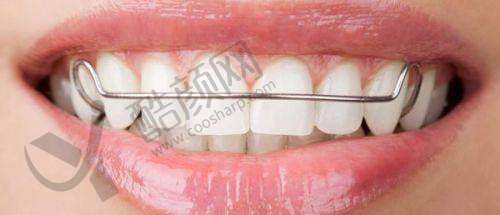 玉溪舒尔口腔全口活动义齿真实评价