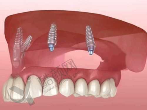 沈阳国睿口腔喷砂洗牙项目真实评价