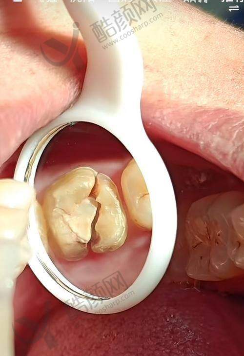 玉溪舒尔口腔根管治疗价格480元起,平价优质服务,助您畅享口腔健康!