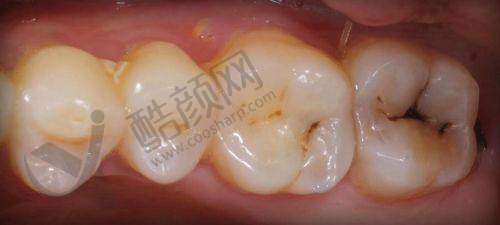 玉溪舒尔口腔补牙120元起,多材料可选,高性价比口腔诊疗服务等你来享