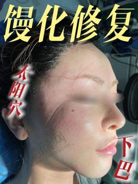 郭鑫取生长因子成功实例：成效显著，患者满意