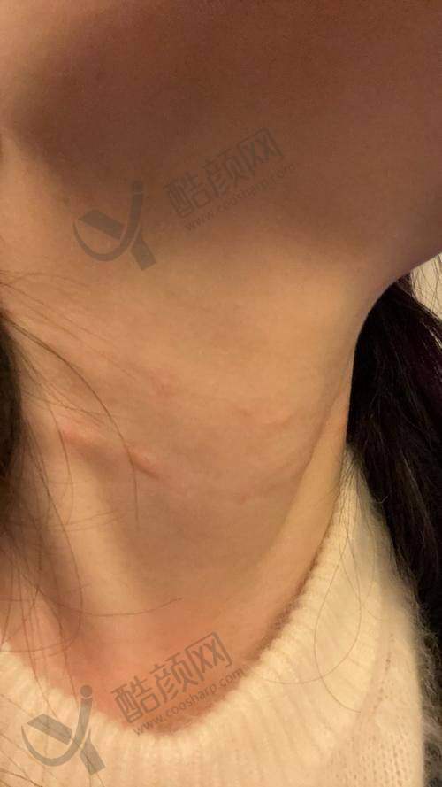 北京美莱医疗美容医院嗨体颈纹项目真实评价
