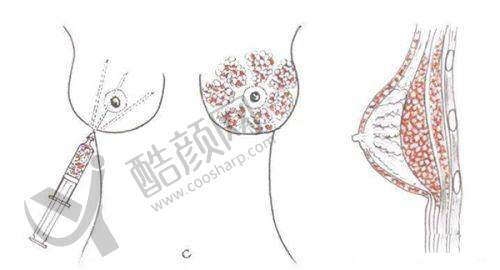 东莞爱思特魏鑫铭眼部综合整形水平怎么样可靠吗?