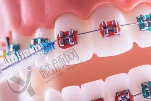 选择适合自己的隐形矫正方案