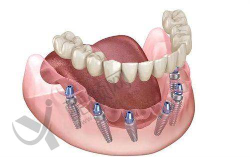 西安武海波医生种植牙水平怎么样可靠吗?