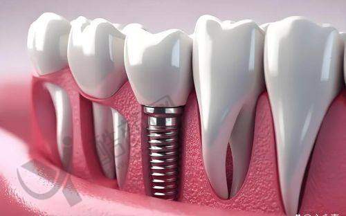 西安武海波医生种植牙实例