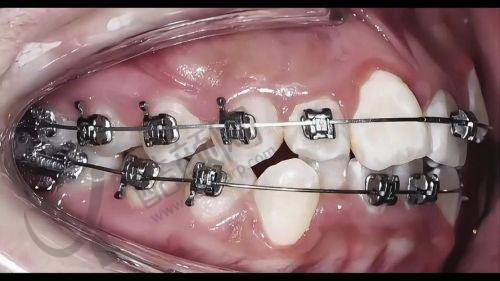 时代天使和隐适美价格对比