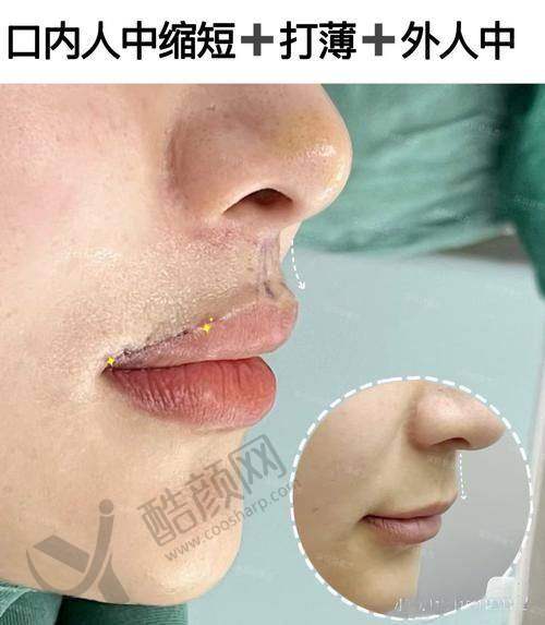 谭拯人中缩短成功实例