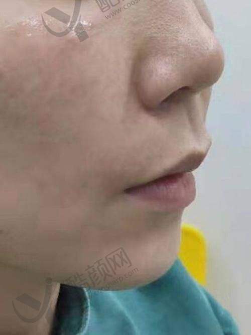 谭拯人中缩短手术技术特点