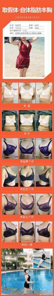 石家庄天宏医疗美容医院:连锁大品牌,丰胸有保护