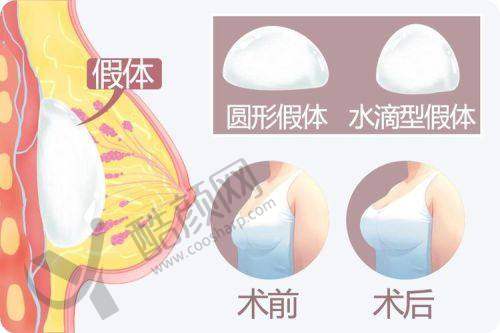 中南大学湘雅医院整形科——隆胸界的老牌劲旅