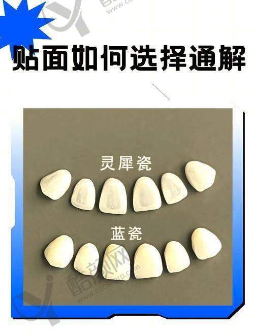 杭州瑞创口腔超薄全瓷贴面的真实评价