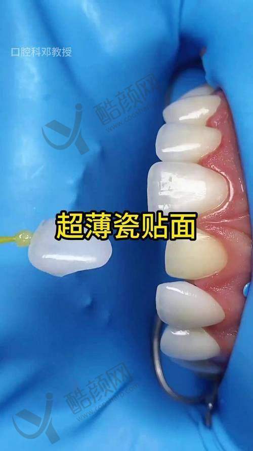 杭州瑞创口腔超薄全瓷贴面的优势