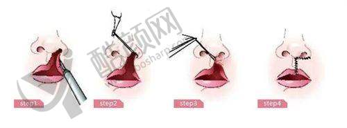 深圳整形吸脂的注意事项