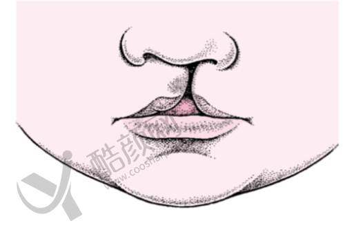 八大处宋涛:唇腭裂修复实例