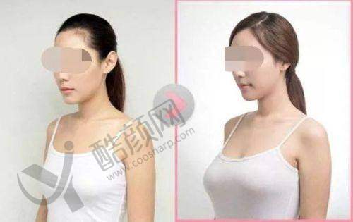 梁耀婵隆胸价格及口碑