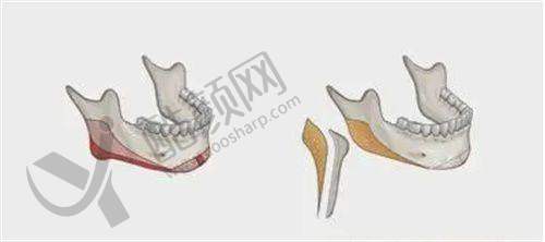 成都米兰柏羽整形医院的价格优势