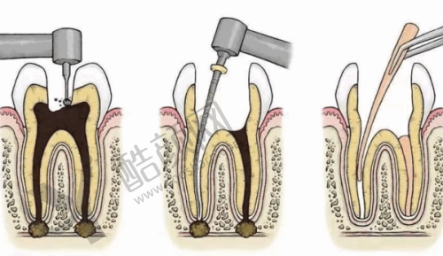 上海铭植口腔连锁根管治疗性价比凸显