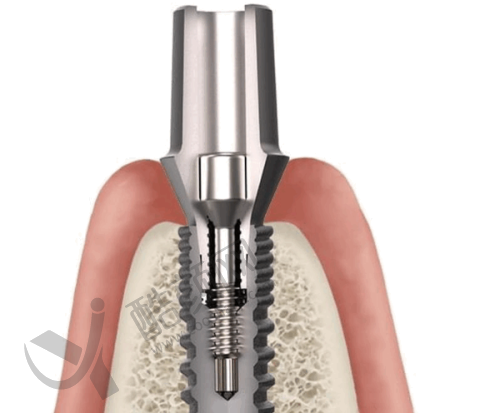 深圳麦芽口腔与格伦菲尔口腔价格对比