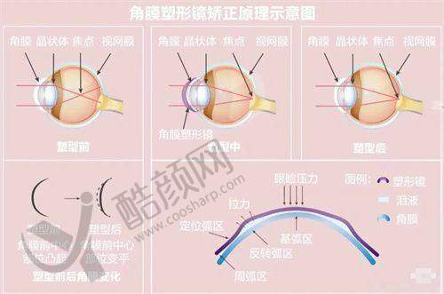 沈阳四院眼科近视手术收费揭秘
